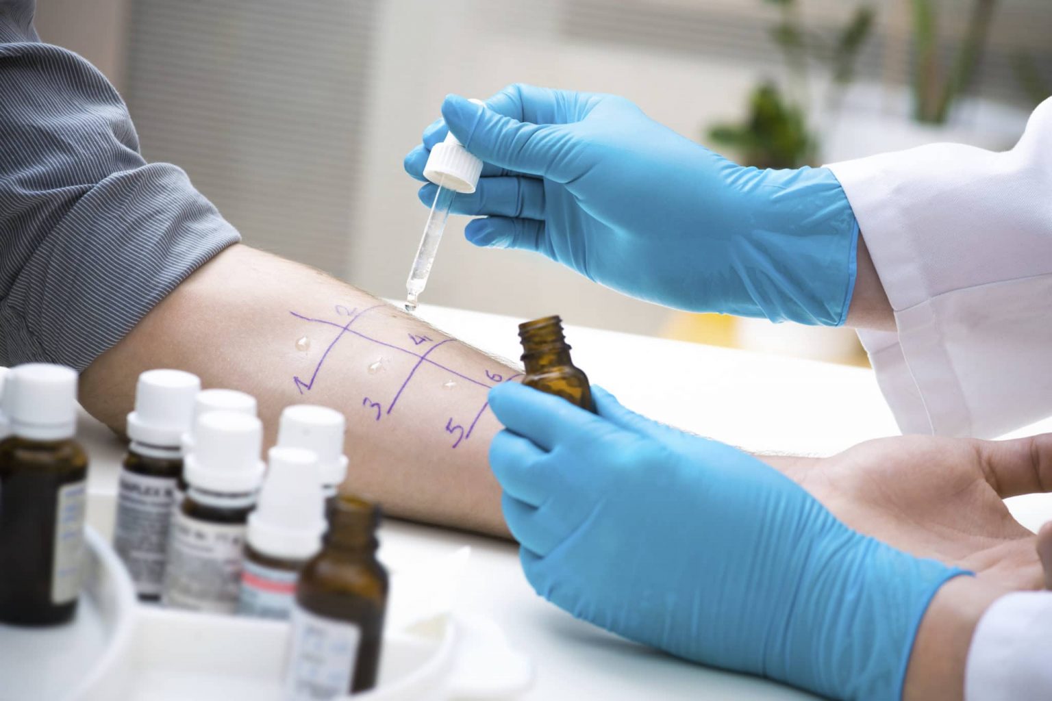 Skin prick allergy test Doctor with gloves on using dropper to run an allergy test on patient's forearm