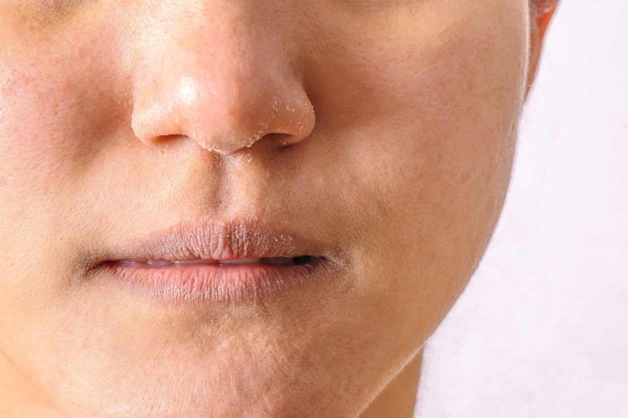 Close up of a person with dry nose